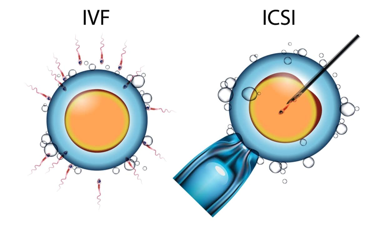 ivf icsi