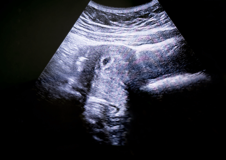 Abortion Figures in France for 2023