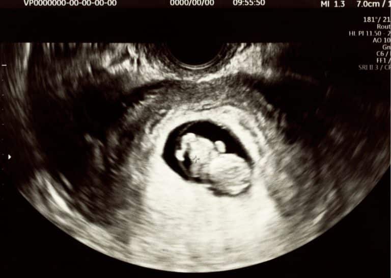 chirurgie fœtale et cellules souches, 4 questions au professeur emmanuel sapin